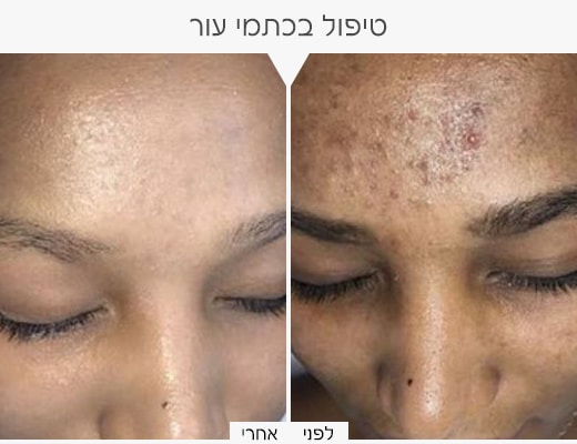 כתמי-עור-4