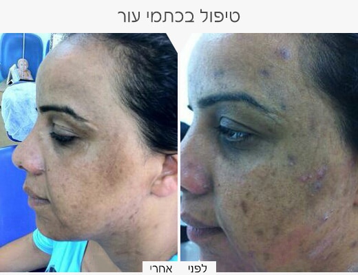 כתמי-עור-5