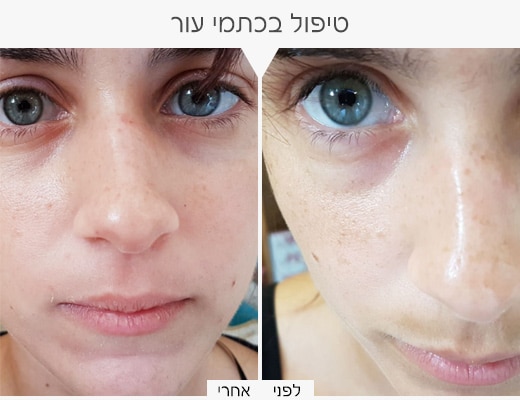 כתמי-עור2