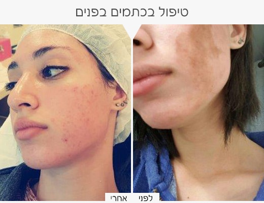 כתמים-בפנים